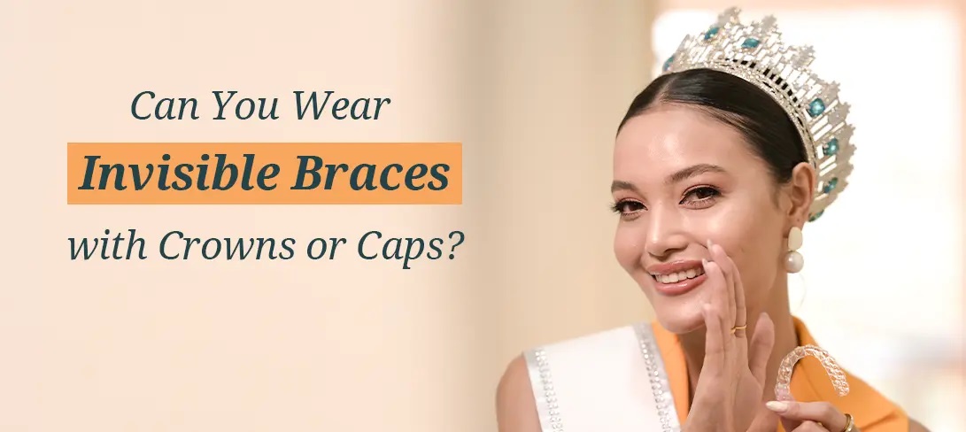 Aligners and Braces