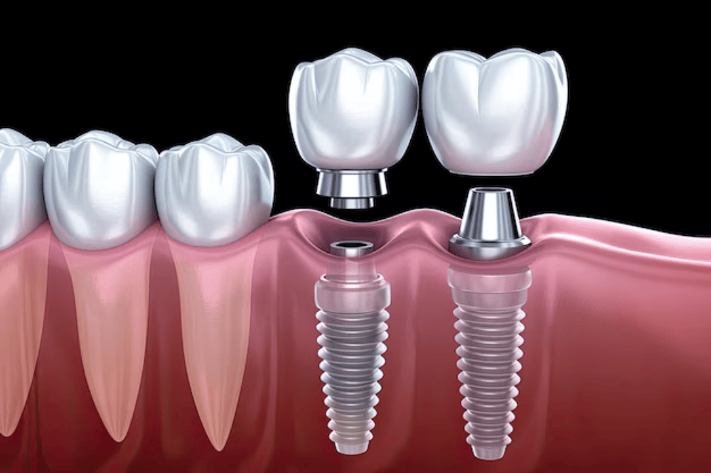 Teeth Braces Cost in India